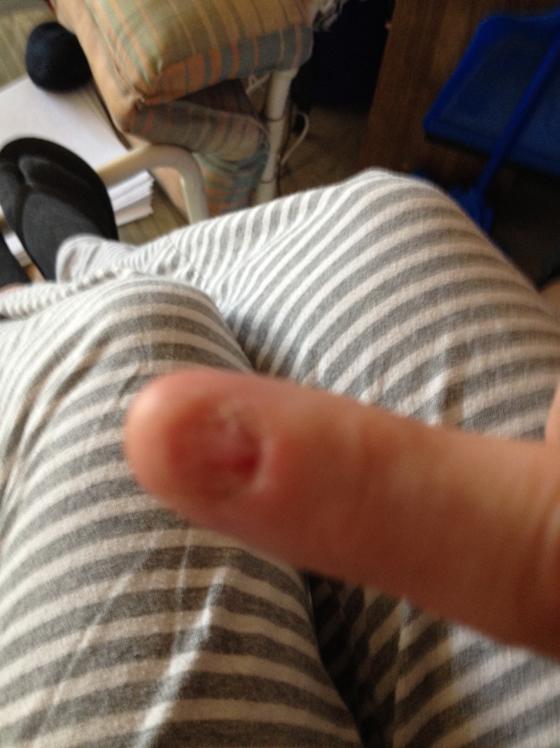 Illustration for article titled A gross post about my gross nail - HALP!